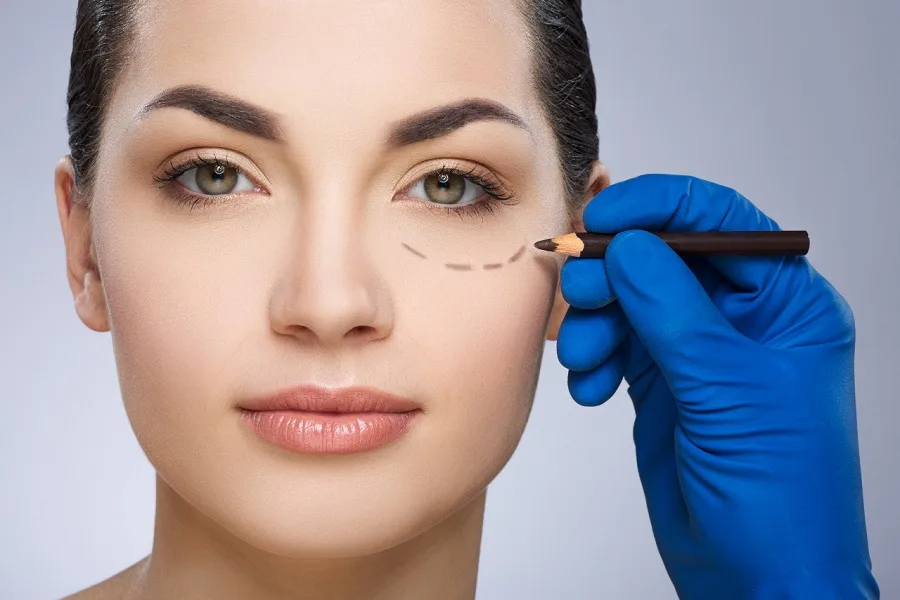 Treating wrinkles around the eyes with filler