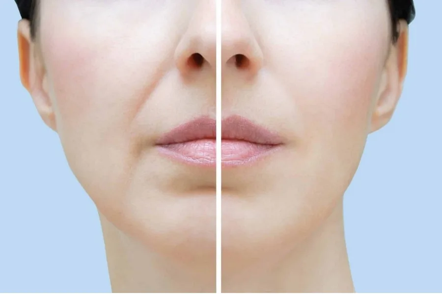 How to correct smile lines and marionette lines with filler