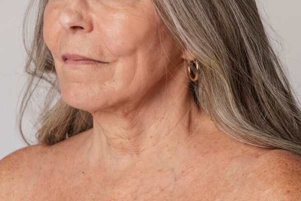 درمان افتادگی پوست: برای سفت شدن پوست چه کار کنیم؟